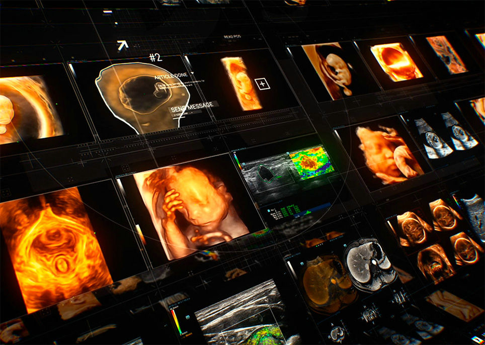 超声智能应用， 让更多女性享有 高质高效的超声诊断